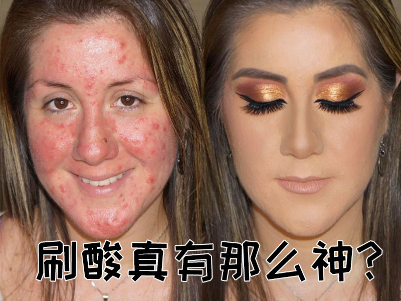 你知道如何度过刷酸爆痘期么?