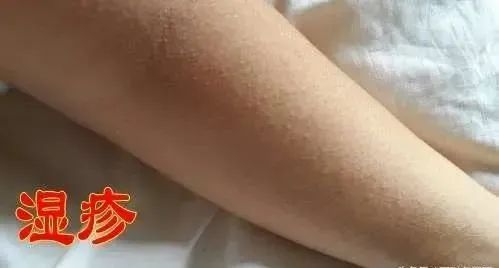 春季皮肤病来袭湿疹皮炎荨麻疹宝宝一不注意就中招