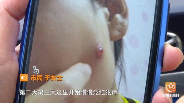 常州一女子疑似注射瘦臉針失敗臉頰潰爛流膿致毀容