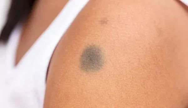 皮肤癌早期常常给出3个"警告信号",必须重视起来!