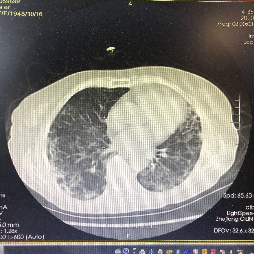 新冠治好了肺部图片图片
