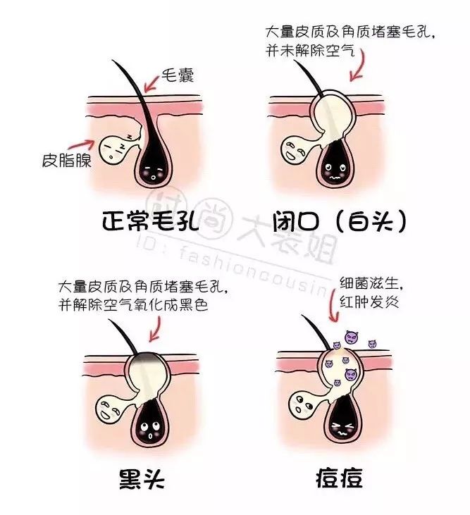 做对这件事很关键_痘痘