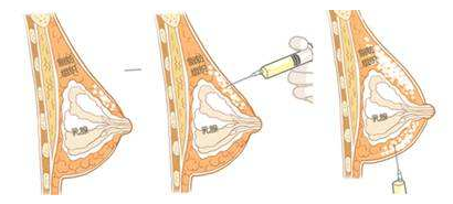 隆胸是通過植入乳房假體或者填充自身的脂肪,使乳房形態飽滿勻稱且
