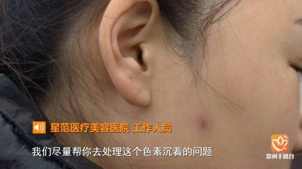 常州一女子疑似注射瘦脸针失败脸颊溃烂流脓致毁容