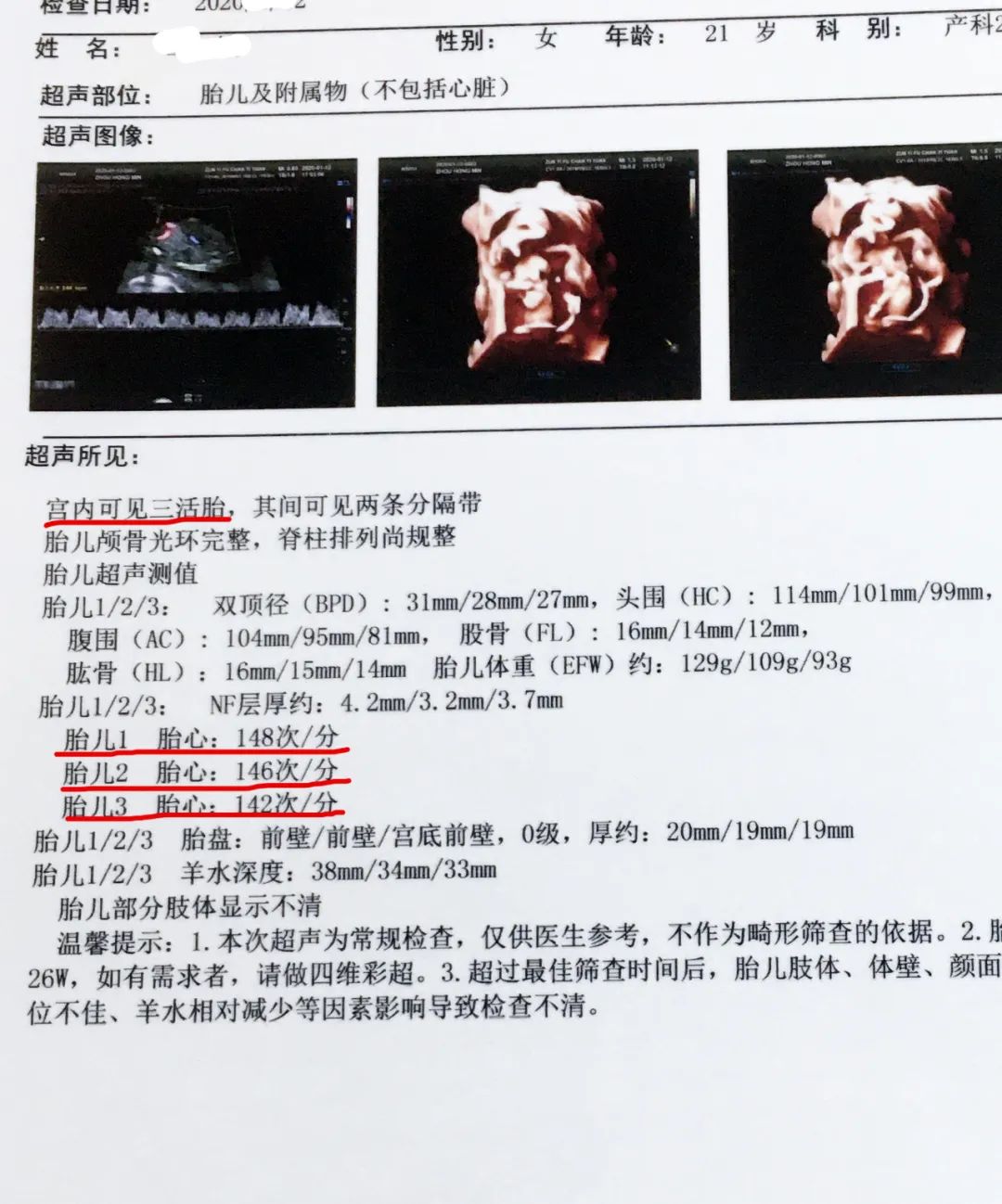 我院四维5d彩超下的双胞胎三胞胎是怎样的看到的都有好运孕哦