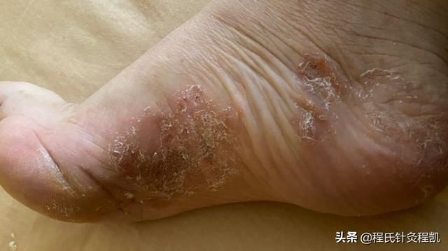 脚上长湿疹怎么治疗图片
