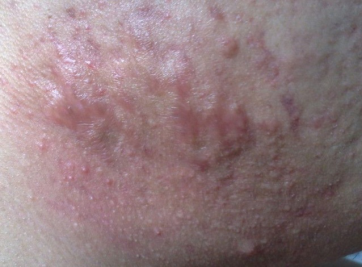 就会变成结节和囊肿,也就会向着皮肤的内层进展的深在的皮疹,这时候