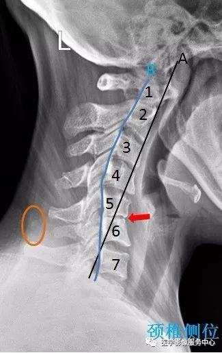 颈椎生理弧线b出现反弓c5/6椎间隙明显变窄
