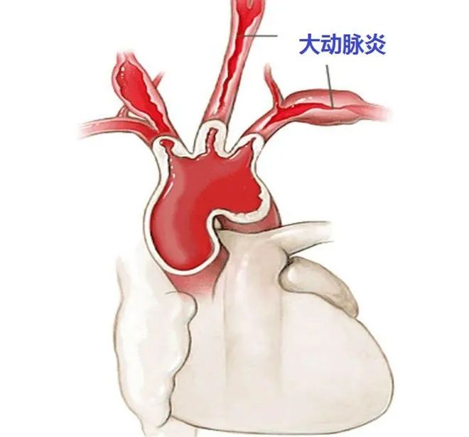 本病多累及主動脈弓及其分支(圖3),其次為降主動脈,腹主動脈和腎動脈