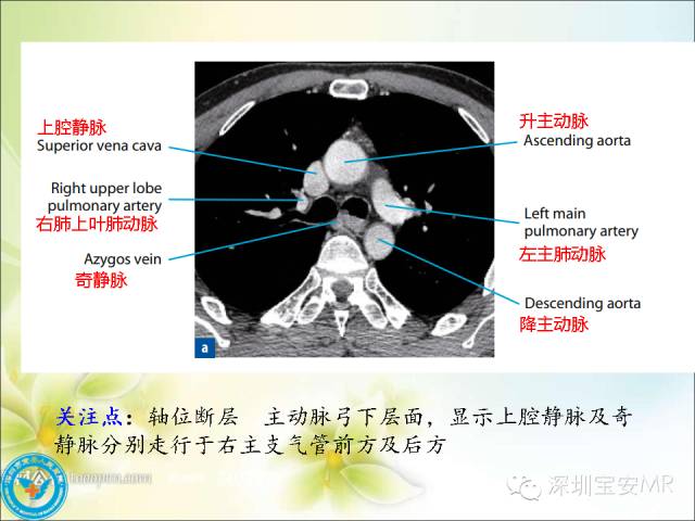 肺动脉和肺静脉影像断层解剖