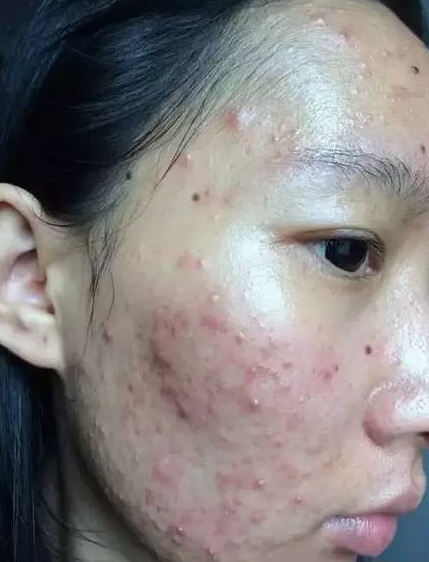 一个爱长痘的人,尽快戒掉这些习惯,摆脱反复长痘的困扰!