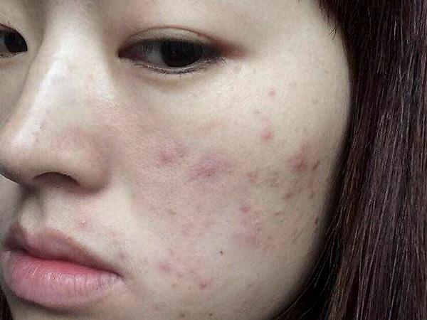 脸上长痘是内分泌失调找对原因对症下药让痘痘不敢来