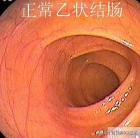 正常乙状结肠长度15