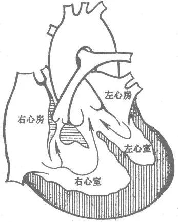 右心室肥大◆主动脉右位(骑跨 于缺损的心室间隔 上)◆心室间隔缺损