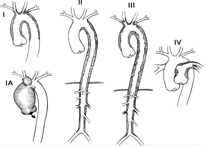 28岁女性脉搏测不到,血压难测知,她怎么了?_桡动脉