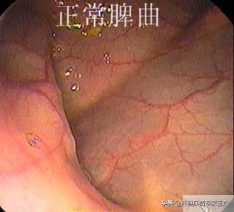 结肠镜检查痛苦并快乐着