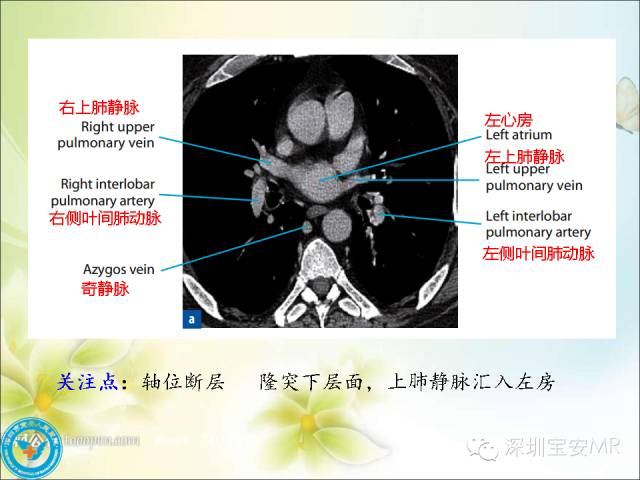 肺动脉和肺静脉影像断层解剖