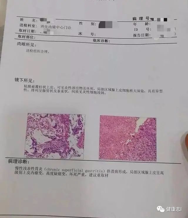 26岁小伙呕血,查出胃癌晚期,医生:只因他下班常去吃这种食物