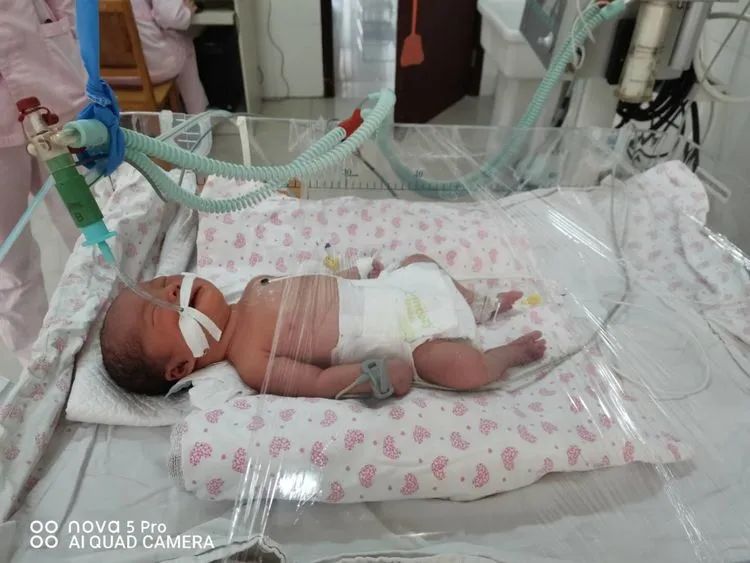 我院首例应用高频呼吸机成功抢救危重早产儿