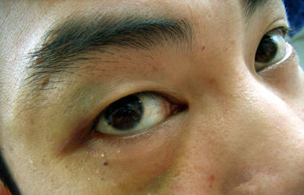 黑眼圈只有黑色?若有这些颜色,是脏腑在呼救,需对"圈"下药!