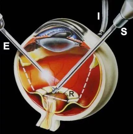 青岛市胶州中心医院微创玻切术清扫眼前障碍核心技术项目一