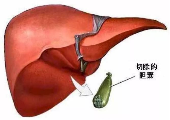 胆囊切除了结石就消失了吗关于胆囊结石的真相在这里