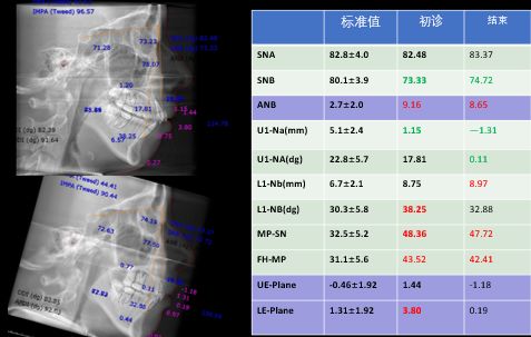 头颅侧位片对比