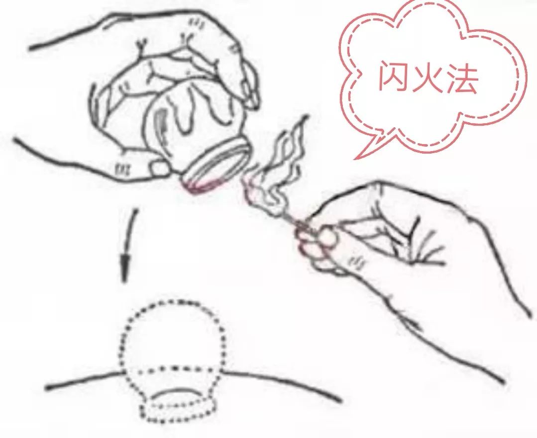 拔罐知多少小小拔罐中的大学问