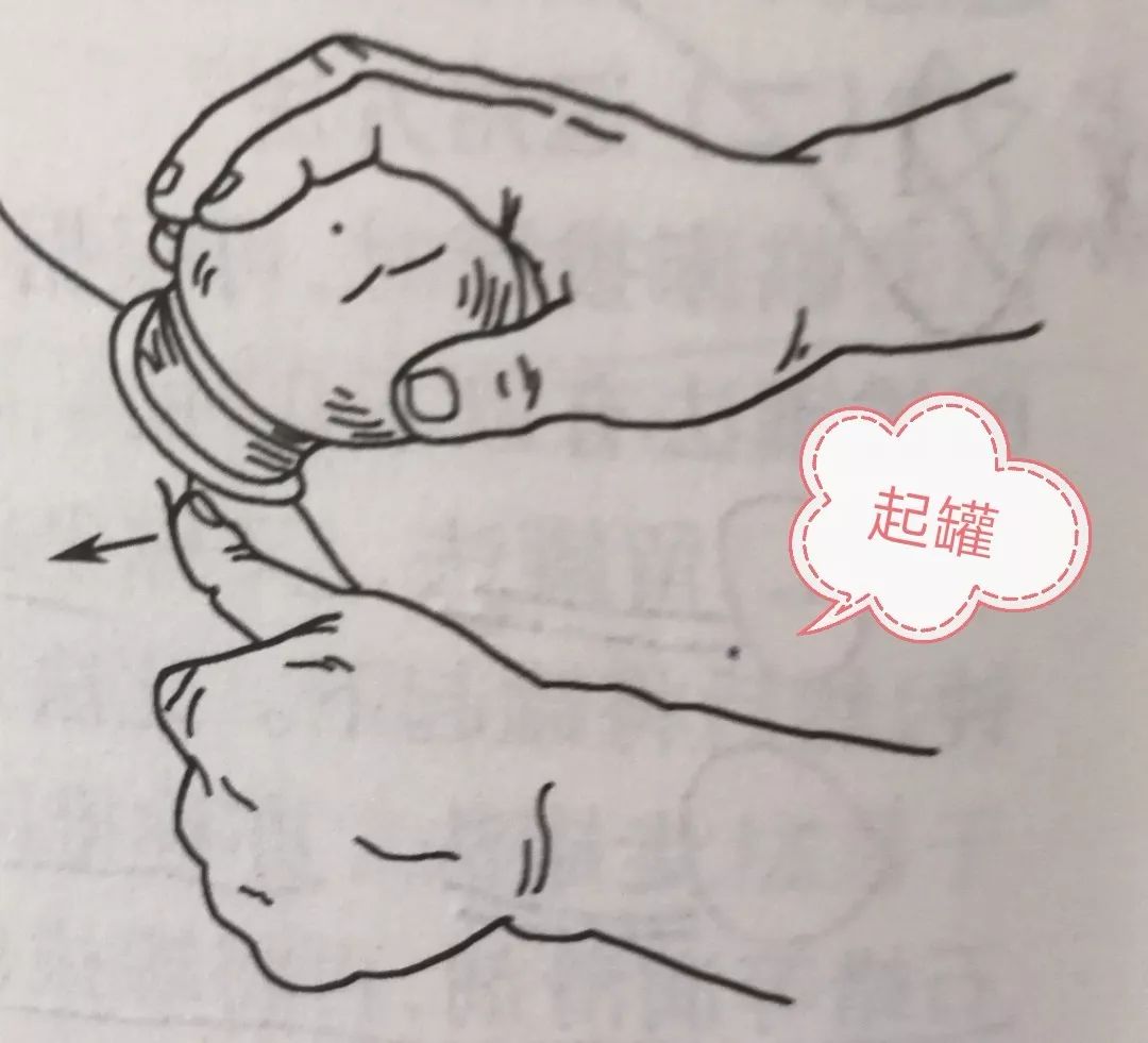 拔罐知多少小小拔罐中的大学问