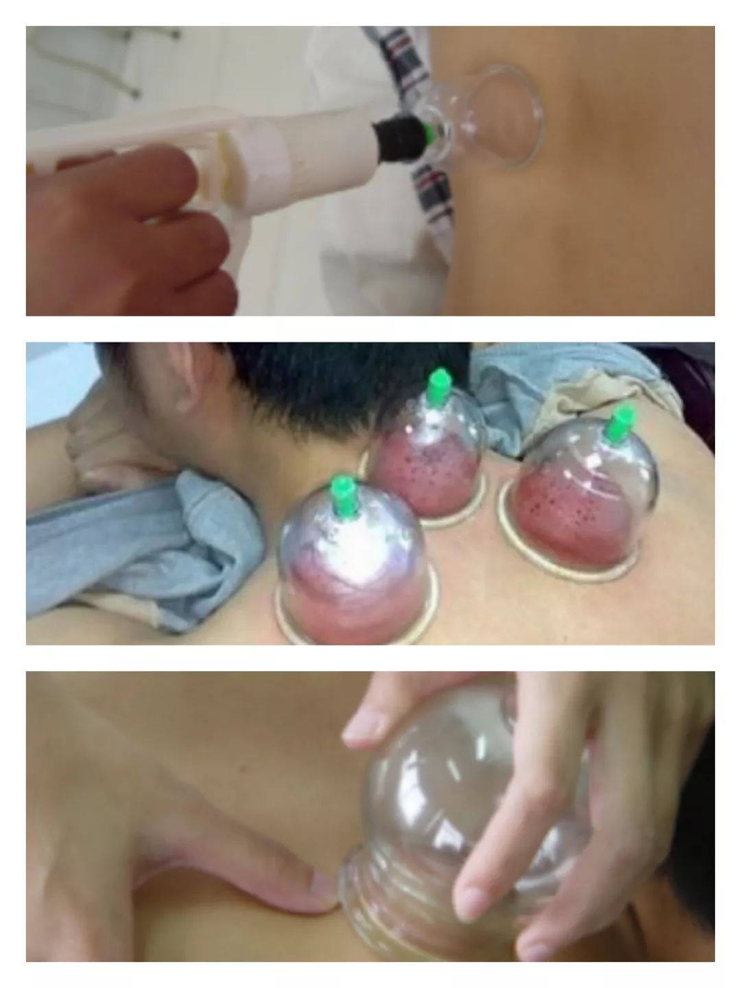 常用器具抽气罐罐,酒精,打火机,棉球,止血钳(镊子)1.拔罐工具有哪些?