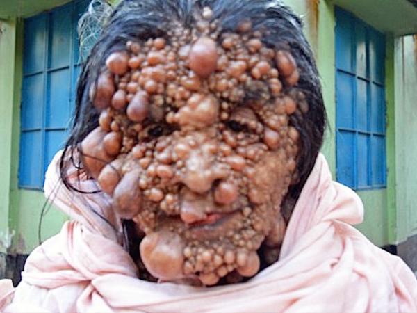 印度60岁老妇患罕见怪病全身长满肉瘤痛似火烧