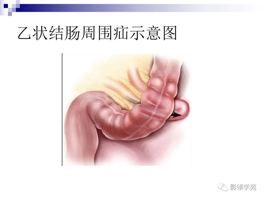 腰骶筋膜脂肪疝图片图片