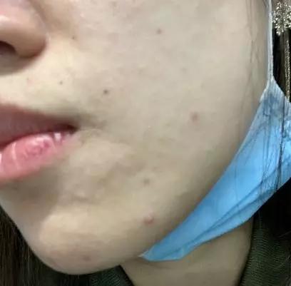 戴口罩长痘怎么办这个来自法国的清痘精华液好用哭了