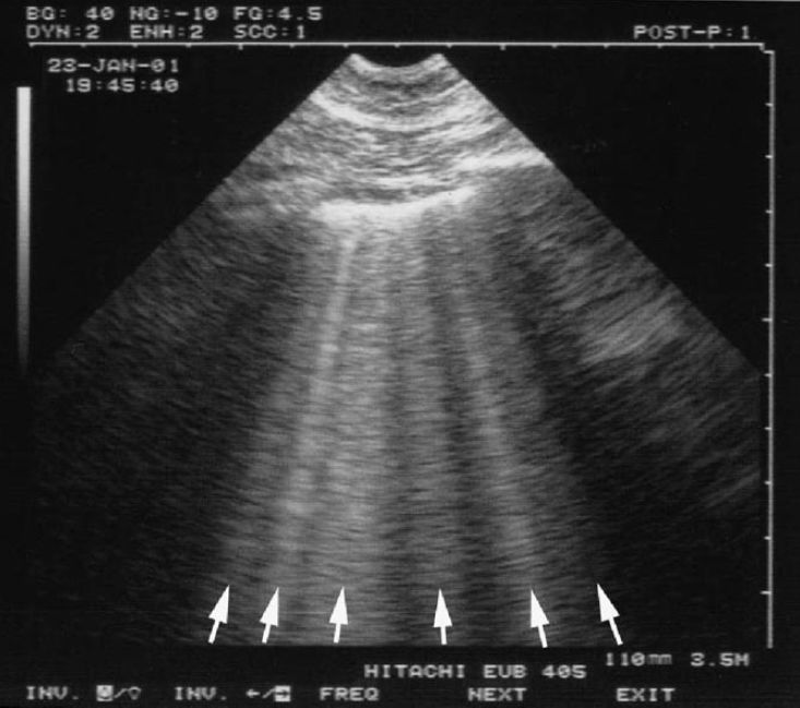 重症肺部超声对呼吸困难患者的鉴别(肺炎,ards心源性肺水肿等)科研