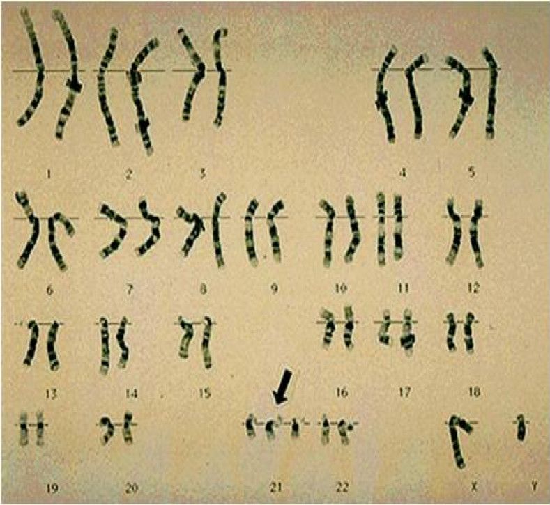 唐氏综合症科普知识——唐氏综合症定义_染色体
