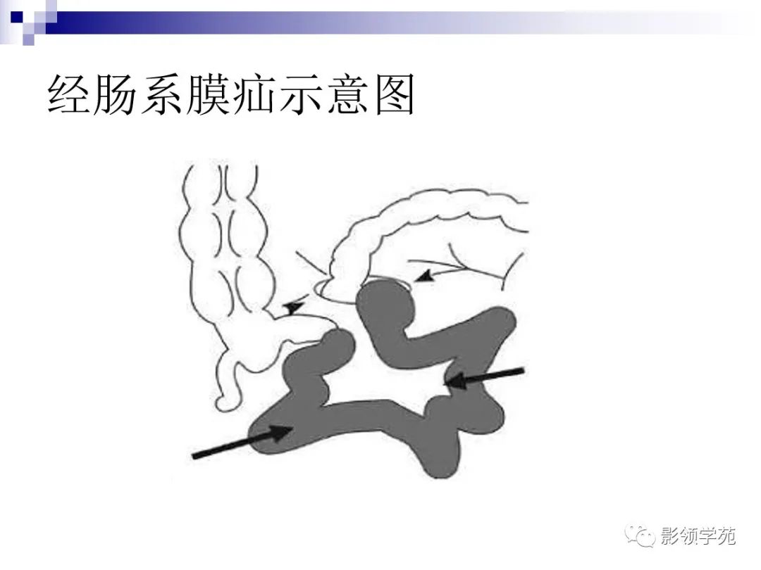 7种类型腹内疝的影像学表现