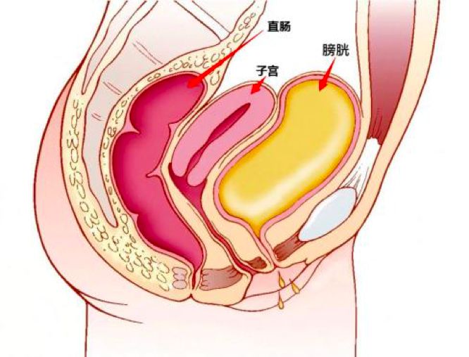 子宫位于盆腔中央,前面是膀胱,后面是直肠,子宫里长了肌瘤,压迫膀胱和