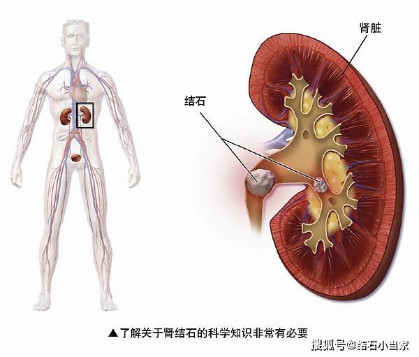 感染尿內常形成磷酸鎂銨結石,這種惡性循環使病情加重