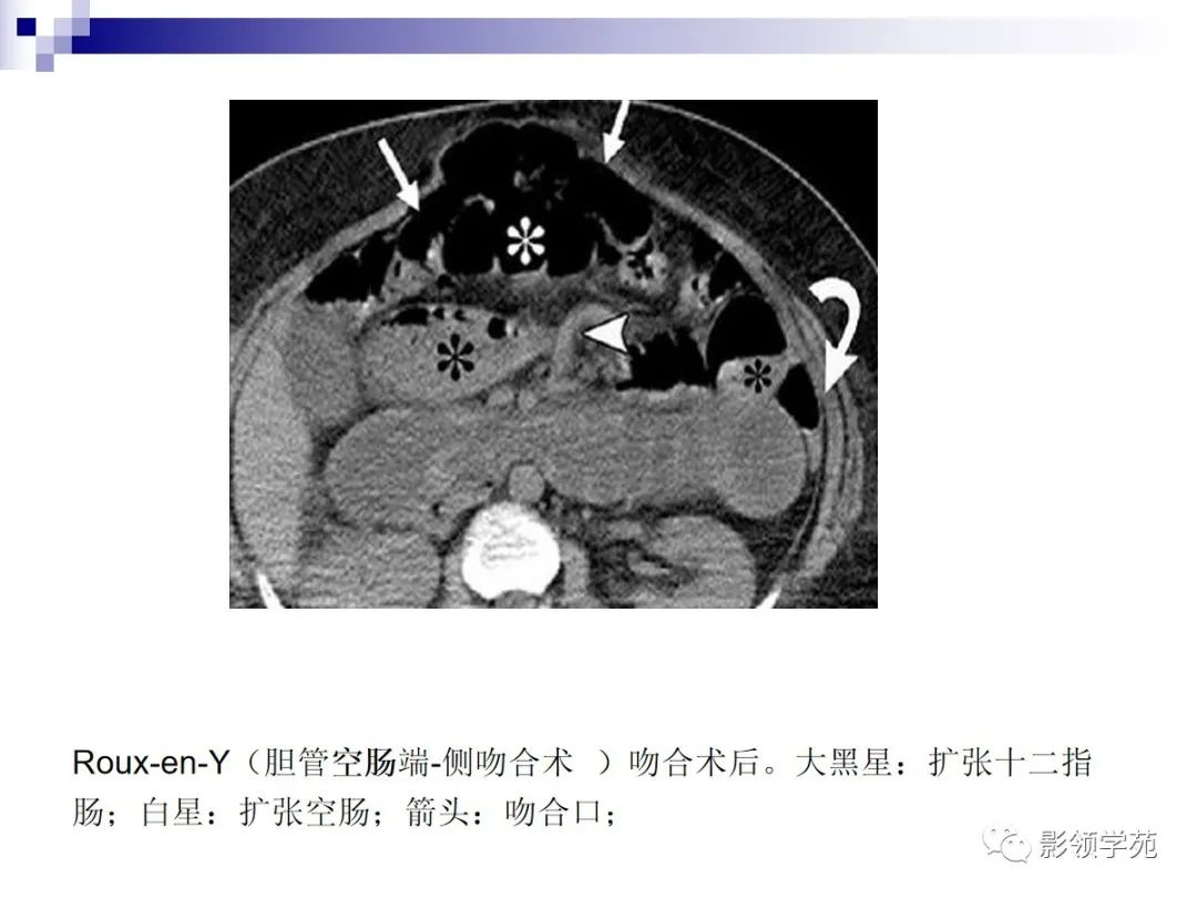 7种类型腹内疝的影像学表现