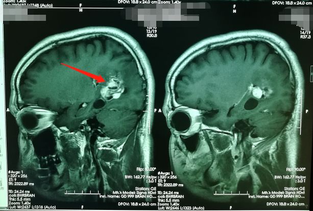 我院頭顱mri顯示患者右側顳頂枕葉-胼胝體壓部存在佔位病灶,結合患者