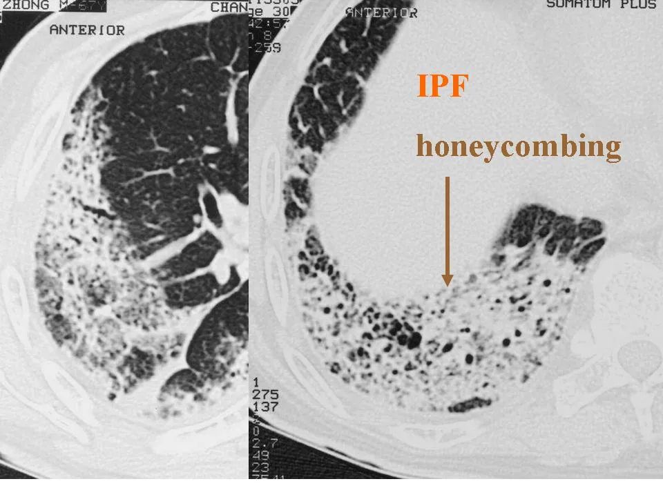 细支气管肺泡癌的影像学_李惠民