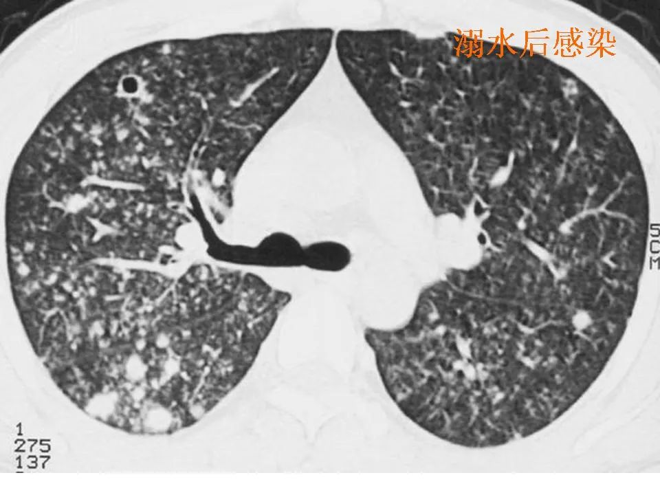 细支气管肺泡癌的影像学_李惠民
