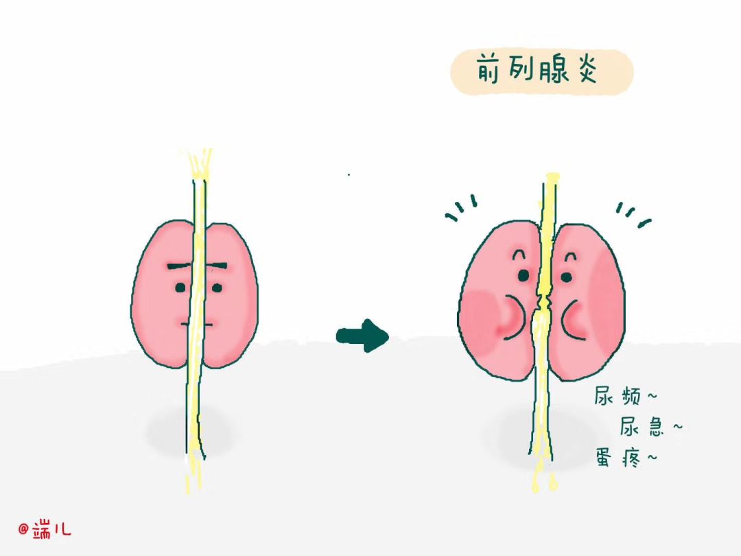 前列腺炎,尤其是慢性前列腺炎是泌尿男性生殖系统最常见的疾病之一.4.