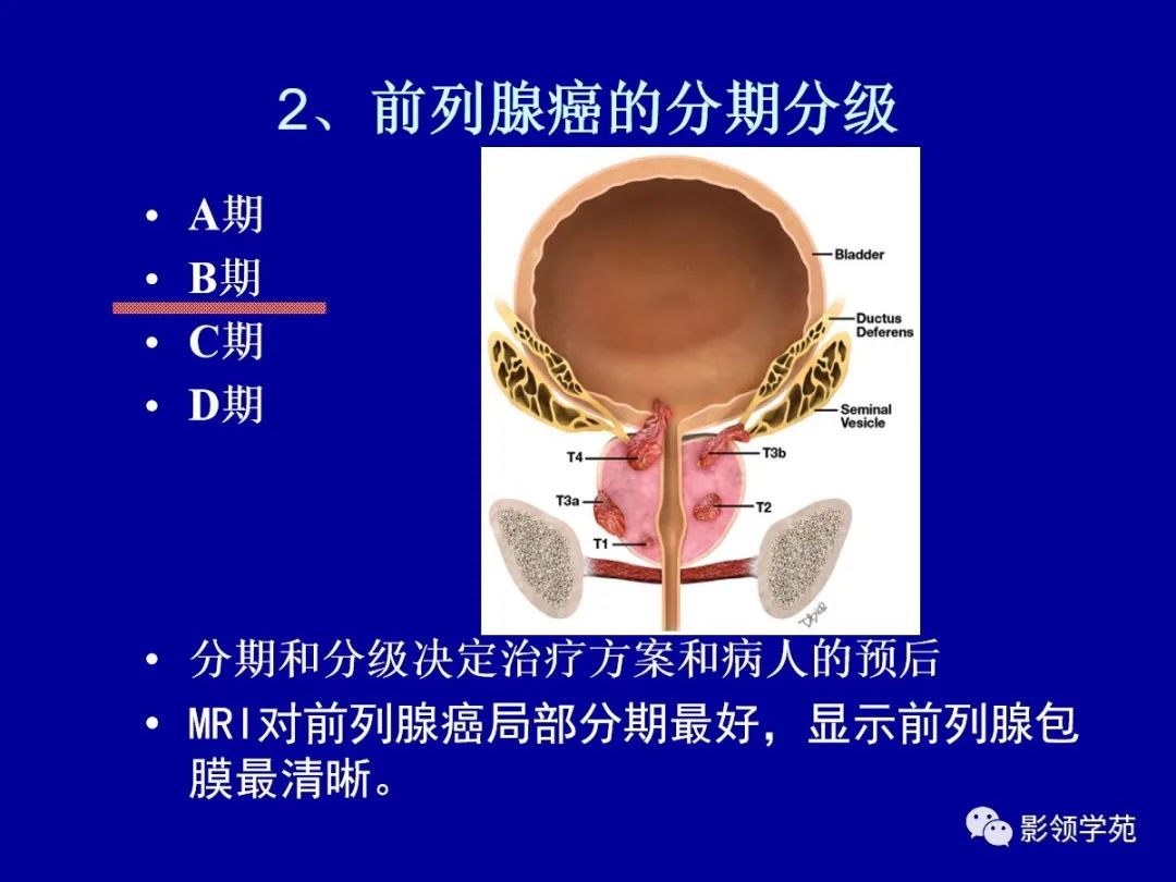 前列腺解剖及mri影像表现