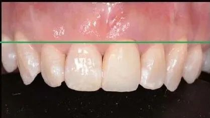 图2 cbct图1 患者口内情况病例患者前牙外伤,21没有理想的牙本质肩领