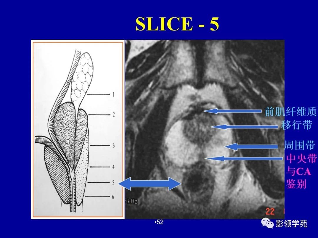 前列腺解剖及mri影像表现