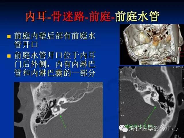 内听道磁共振解剖图图片