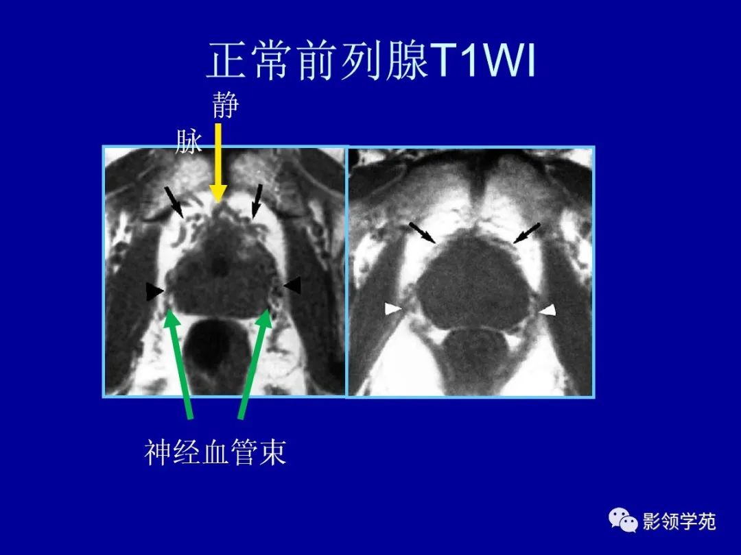 前列腺磁共振正常图像图片