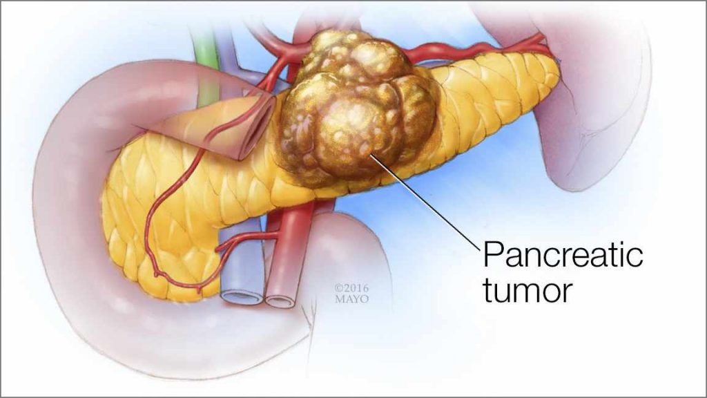胰头癌示意图图片