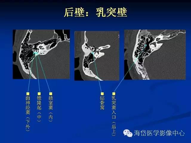 耳部ct及mri解剖